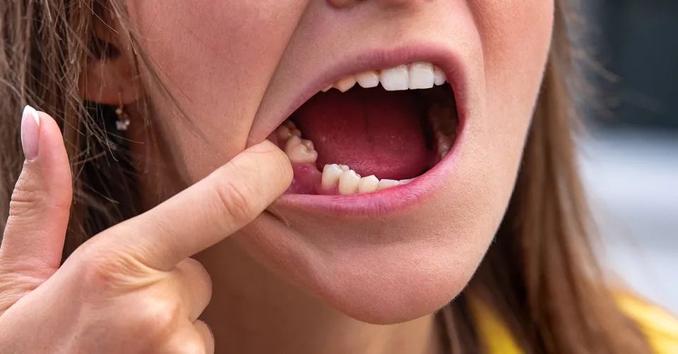 Dental Tooth Replacement Options Explained. How to Fix Missing Teeth?