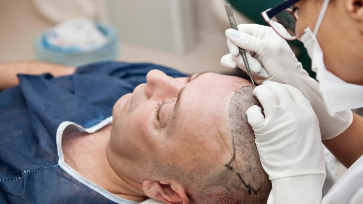 Overview f Hair Transplant And Its Process