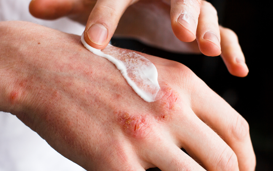 Atopic Dermatitis: Dry Skin or Eczema?