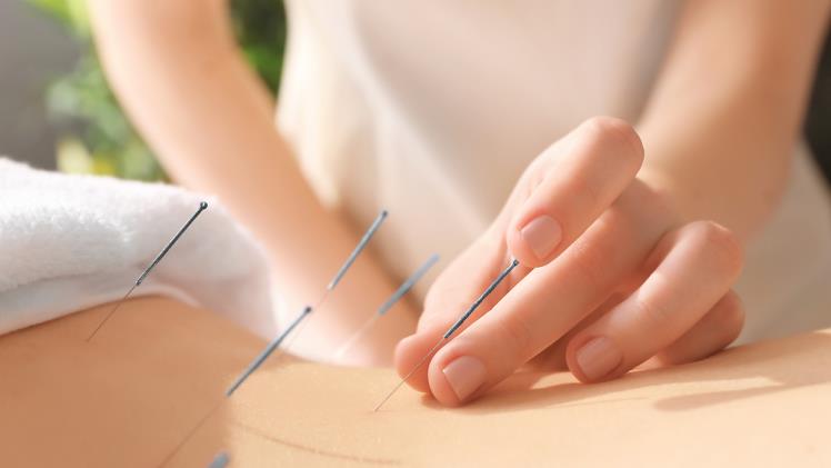Acupuncture For Stress Relief And Emotional Well-being