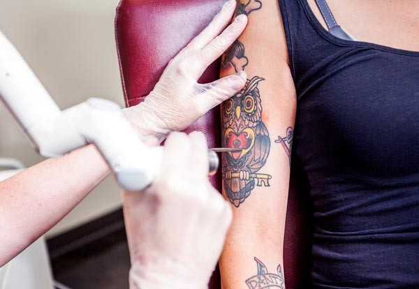 How Expensive Is Tattoo Removal?